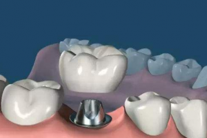 2020瀘州微笑口腔專(zhuān)科醫(yī)院整形價(jià)格表(價(jià)目表)全新發(fā)布