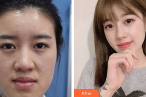 重慶時(shí)光整形美容醫(yī)院姜民范整形價(jià)格表附假體隆鼻案例展示