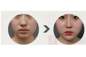 什么是頦部填充術(shù)，如何快速消腫