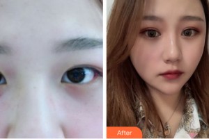 海南伊佳醫(yī)療美容醫(yī)院丁合軍整形價(jià)格表附眼部手術(shù)案例展示