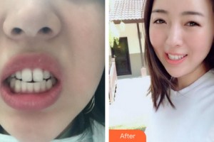 沈陽金皇后整形美容醫(yī)院管宇整形價(jià)格表附牙齒矯正案例展示