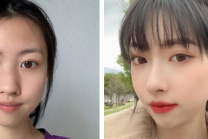 昆明吳氏嘉美美容醫(yī)院吳自強整形價格表附自體肋軟骨隆鼻案例展示