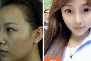 上海天大醫(yī)療美容醫(yī)院劉斌整形價格表附顴骨+頰脂墊+中面部提升術(shù)案例展示