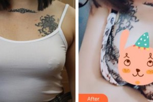 上海解放軍第八五醫(yī)院整形美容科倪俊整形價(jià)格表附假體隆胸案例展示