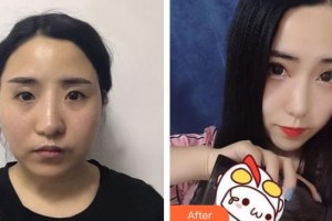 上海解放軍第四五五醫(yī)院激光整形科黃佰乾麻醉科副主任 整形價(jià)格表附眼部手術(shù)案例展示