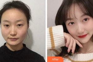 上海美之源整形外科醫(yī)院陳乃理整形價格表附下頜角磨骨案例展示