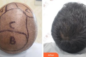 上海解放軍第四五五醫(yī)院激光整形科李桂海整形價格表附頭發(fā)種植案例展示