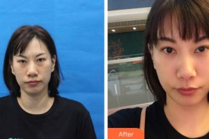 上海伊美爾港華醫(yī)療美容醫(yī)院張毅整形價格表附眼部綜合案例展示