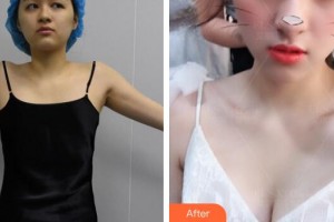 廣州現(xiàn)代醫(yī)院數(shù)字化整形美容中心劉濤整形價(jià)格表附自體脂肪隆胸案例展示