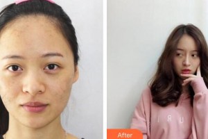 廣州軍區(qū)總醫(yī)院全軍激光整形美容中心廖元興整形價(jià)格表附激光美膚激光祛斑案例展示