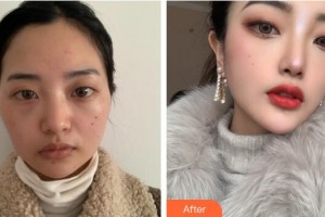 廣州博仕整形美容醫(yī)院謝明英整形價(jià)格表附顴骨+下頜角案例展示