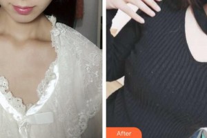 廣州星團(tuán)醫(yī)學(xué)美容門診部楊昆兵整形價(jià)格表附假體隆胸案例展示