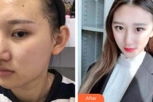 廣州星團醫(yī)學美容門診部廖國善整形價格表附面部吸脂瘦臉案例展示