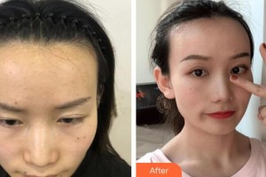 廣州醫(yī)學院第二附屬醫(yī)院整形美容中心楊志強整形價格表附發(fā)際線種植案例展示