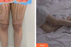 廣州星團醫(yī)學美容門診部顧鵬整形價格表附大腿吸脂案例展示