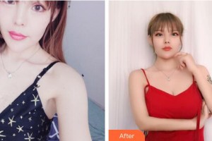 廣州醫(yī)學院第二附屬醫(yī)院整形美容中心聶冬生整形價格表附假體隆胸案例展示