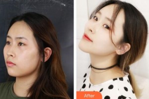 廣州壹加壹美容醫(yī)院河?xùn)|鎬整形價格表附面部吸脂瘦臉術(shù)案例展示