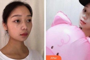 廣州曙光醫(yī)學美容醫(yī)院劉海峰整形價格表附水氧活膚案例展示