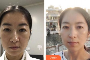 廣州曙光醫(yī)學美容醫(yī)院單良整形價格表附熱瑪吉案例展示