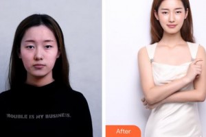 上海華美醫(yī)療美容醫(yī)院田波整形價(jià)格表附法國(guó)青春動(dòng)能素補(bǔ)水嫩膚，除皺案例展示