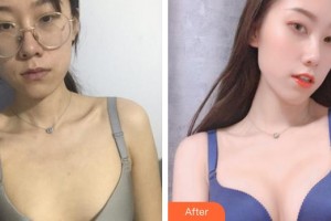 上海美立方整形醫(yī)院李斌整形價(jià)格表附濃縮脂肪豐胸案例展示