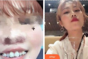 上海滬西醫(yī)院醫(yī)療美容科祖開(kāi)慧整形價(jià)格表附隱形托槽案例展示