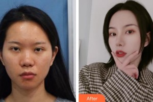 上海二醫(yī)大附屬第九人民醫(yī)院整形激光美容中心崔海燕整形價格表附假體隆鼻術案例展示