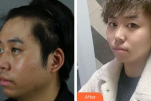 上海首爾麗格醫(yī)療美容醫(yī)院洪性范整形價格表附下頜角+皮質骨+夾脂墊案例展示