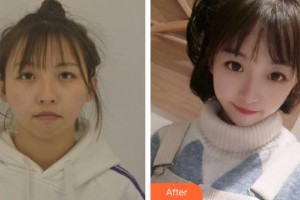 上海諾詩雅醫(yī)療美容醫(yī)院蔡景龍整形價格表附硅膠墊下巴案例展示