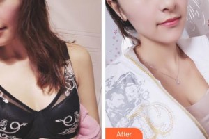 上海港華醫(yī)院浦東分院（悅容醫(yī)療美容診所）陳華生整形價格表附濃縮脂肪豐胸案例展示