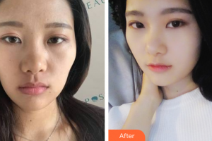 泉州西華醫(yī)療美容醫(yī)院廉樂天整形價格表附抗衰老—緊致祛皺—熱瑪吉案例展示