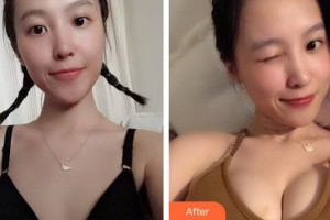 廣州曙光醫(yī)學美容醫(yī)院張元龍整形價格表附濃縮豐胸案例展示