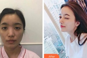 廣州曙光醫(yī)學美容醫(yī)院蔣思軍整形價格表附鼻部手術(shù)案例展示