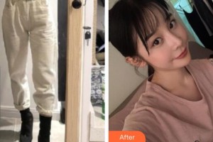 廣州粵秀整形外科醫(yī)院王堅強整形價格表附大腿吸脂案例展示