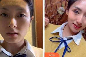 廣州博仕整形美容醫(yī)院李東偉整形價格表附埋線提升案例展示