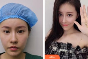 廣州博仕整形美容醫(yī)院李少顏整形價格表附假體墊眉弓案例展示