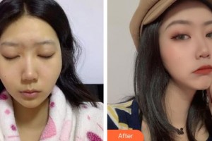 上海仁愛醫(yī)院整形美容科楊洪波整形價格表附顴骨顴弓降低案例展示