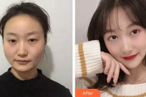 上海麗人整形美容醫(yī)院陳兵整形價(jià)格表附下頜角磨骨案例展示