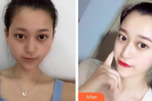 上海麗人整形美容醫(yī)院王小兵整形價(jià)格表附顴骨降低案例展示