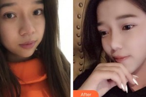 上海麗人整形美容醫(yī)院謝影影整形價(jià)格表附超激光美膚祛斑案例展示