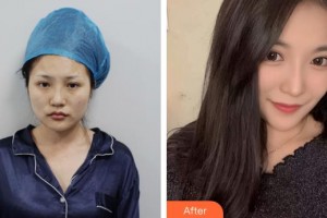 上海麗人整形美容醫(yī)院郭建華整形價(jià)格表附黃金微雕全臉案例展示