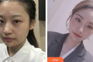 上海麗人整形美容醫(yī)院范鑫整形價(jià)格表附超激光美膚祛斑 美白案例展示