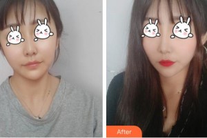 上海麗人整形美容醫(yī)院崔潔整形價(jià)格表附無(wú)針?biāo)獍咐故?>
</a>
<h3 class=