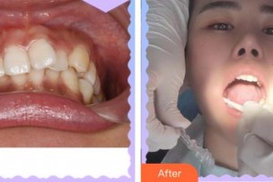 上海華美醫(yī)療美容醫(yī)院張曉峰整形價(jià)格表附牙齒做美容案例展示