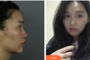 上海宏康醫(yī)院整形美容中心姜元植主診醫(yī)師整形價(jià)格表附	顴骨+頰脂墊+下頜角+皮質(zhì)骨案例展示