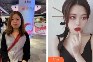 上海解放軍第四五五醫(yī)院激光整形科唐玲整形價(jià)格表附射頻溶脂瘦臉案例展示