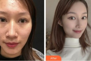 上海康奧醫(yī)療美容醫(yī)院趙華整形價(jià)格表附微針祛痘案例展示