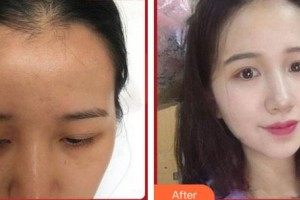 上海康奧醫(yī)療美容醫(yī)院白俊杰整形價(jià)格表附發(fā)際線(xiàn)種植案例展示