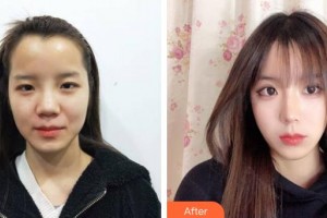 上?？祳W醫(yī)療美容醫(yī)院錢(qián)麟整形價(jià)格表附美鼻部手術(shù)案例展示