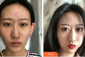 上海康奧醫(yī)療美容醫(yī)院袁智娟整形價(jià)格表附激光去紅血絲案例展示